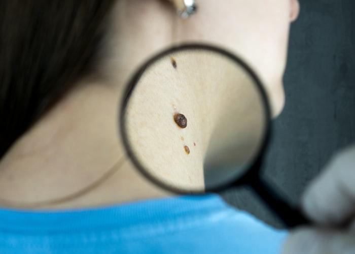 Dermatólogo examinando la piel de un paciente con una lupa